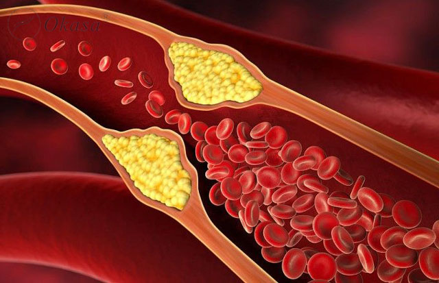 Xơ vữa động mạch có thể gây biến chứng và cách phòng ngừa