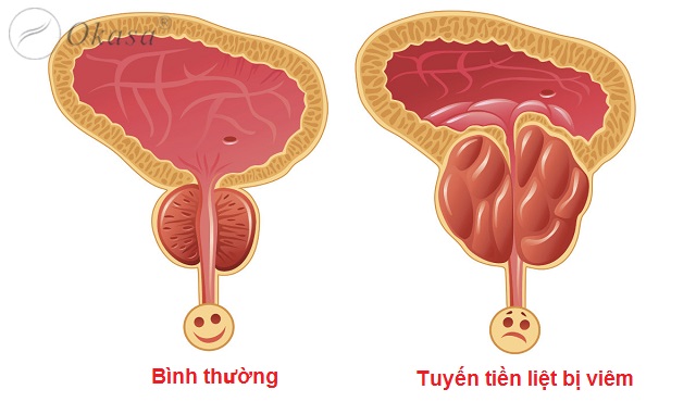 Xoa bóp bấm huyệt trị viêm tuyến tiền liệt