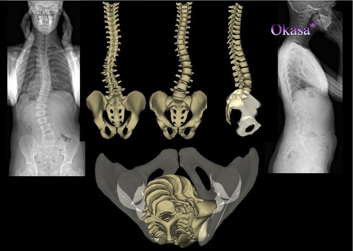 xương bị biến dạng