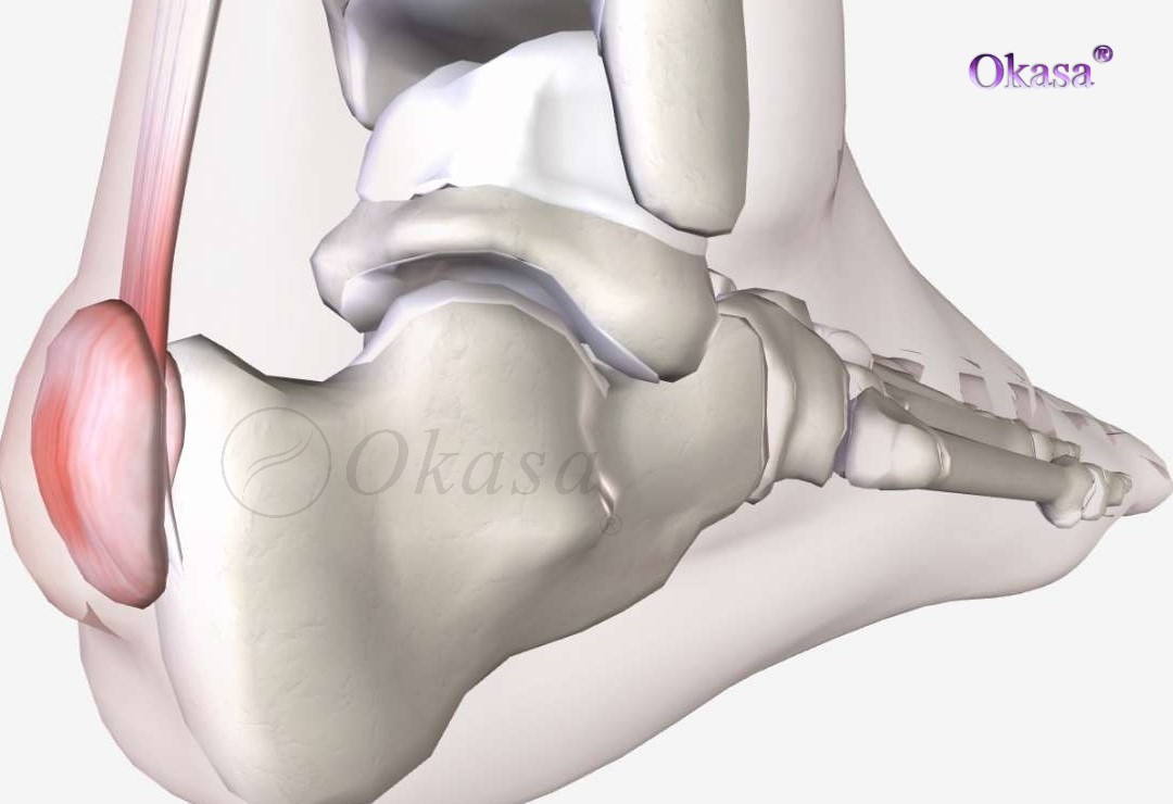 xương biến dạng